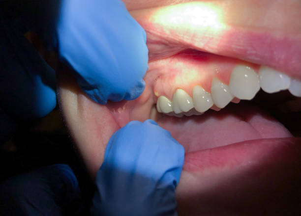 Best Emergency Treatment for Oral Infections in Four Cners, OR
